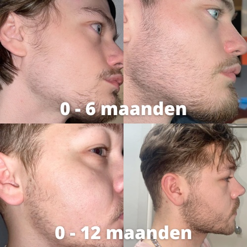 minoxidil baardgroei resultaat